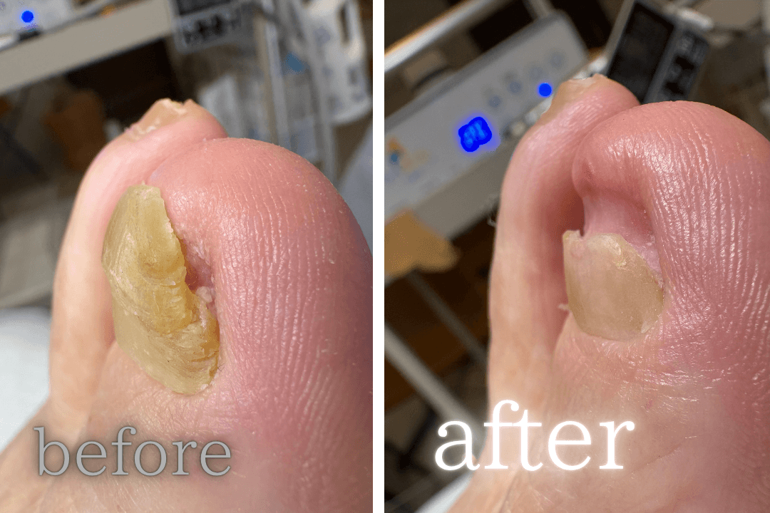 肥厚爪ケア