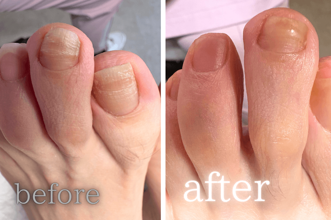 巻き爪ケア