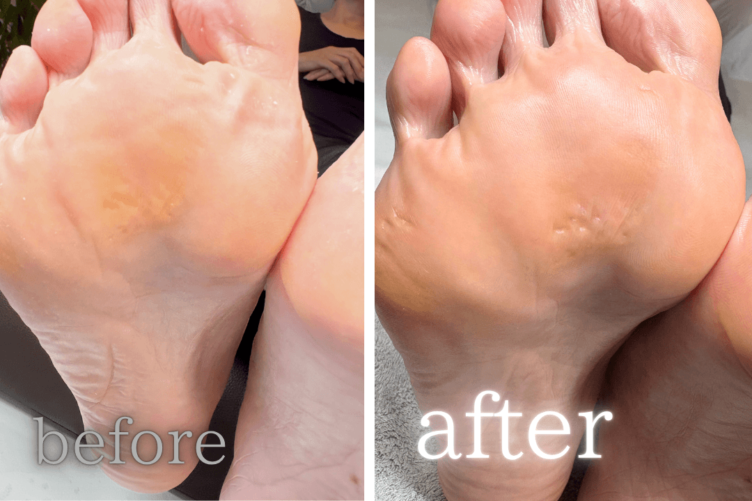 たこ・うおのめケア